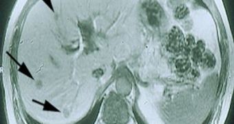 An MRI image, showing liver cancer tumors