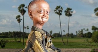 Ali Hussain is suffering from progeria