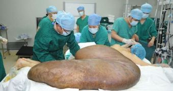 Massive tumor removed from man's wait by doctors in Beijing, China