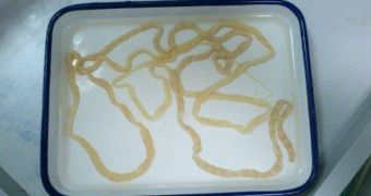 Ginormous tapeworm found inside woman's stomach