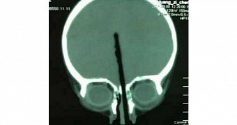 Image shows chopstick stuck inside 2-year-old's brain
