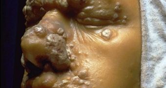 Facial syphilis sores