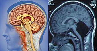 Woman shocked to find out she's been missing part of her brain since infancy