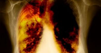 Smoker's lungs kill 27-year-old woman from England