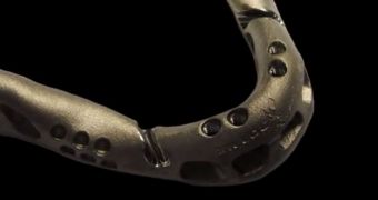 3D Printed Artificial Mandible Transplanted in Old Woman