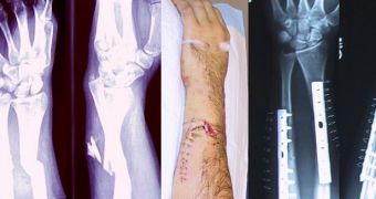 3D printed bone grafts will help heal broken arms like this