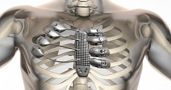 First titanium ribcage made by Lab 22