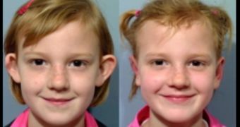 Samantha Shaw, 7, as she was before plastic surgery, when she had her ears pinned back
