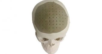 A 3D printed skull prosthetic
