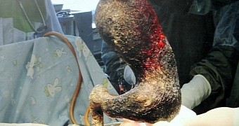 Doctors recover a massive hairball from teenager's stomach