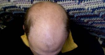 Baldness affects millions of men around the globe, and can be attributed to factors such as stress or genetic predisposition