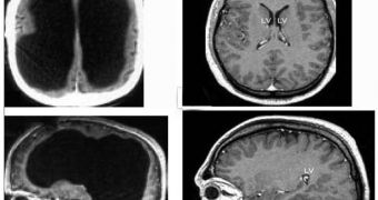 The large black space shows the fluid that replaced much of the patient?s brain (left). For comparison, the images (right) show a typical brain without any abnormalities