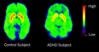 This PET scan shows the brain activity of a typical ADHD patient