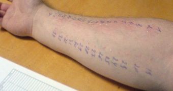 A battery of allergy tests being conducted on an adult test subject