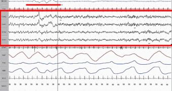 This EEG chart shows brain wave activity during REM sleep