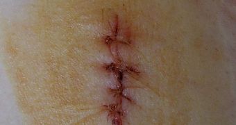 In emergency situation, stitching a wound is not always the best option