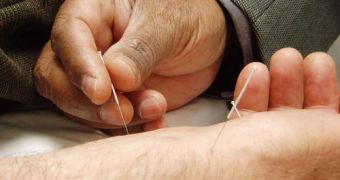 A physician inserts acupuncture needles in the arm of a patient, to alleviate pain