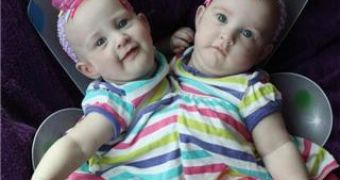 Conjoined twins Allison and Amelia Tucker have been separated