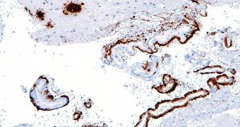 Micrograph showing amyloid beta (brown) in senile plaques