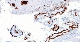 Micrograph showing beta-amyloid plaques (brown) in the brain