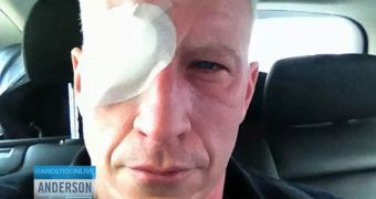 Anderson Cooper went blind for 36 hours after getting his eyeballs sunburnt