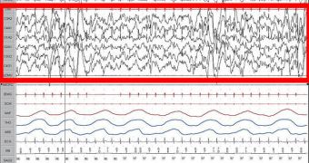 This is a screenshot of a patient during Slow Wave Sleep (stage 4). The high-amplitude EEG is highlighted in red