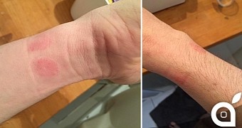 Apple Watch Causes Skin Rashes for Some Users - Photos