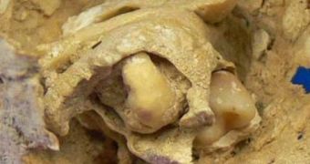 A 1,600-year-old tumor located in Spain, in a woman's body, contains bone and tooth fragments