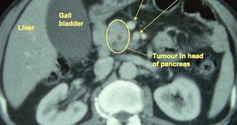An MRI showing a pancreatic cancer tumor in a patient