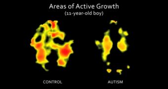 The autistic brain develops in significantly-different patterns at the age of 11 than the healthy brain