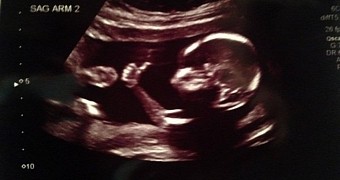 Photo shows baby giving the thumbs up while still in the womb