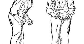 Front and side views of a man portrayed to be suffering from Parkinson's disease