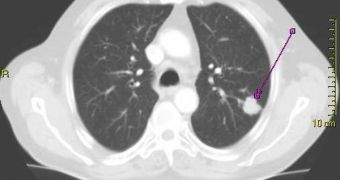 CT scan showing lung cancer tumor (arrow)