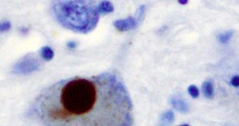 Biomarker Test Detects Parkinson's Very Early On