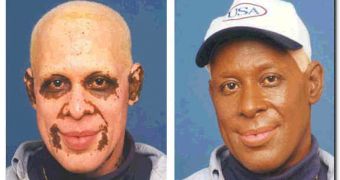Extended vitiligo
