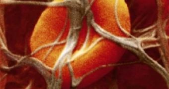 Blood Clots Linked to Dementia