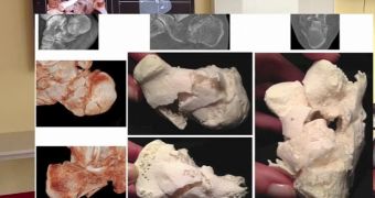 3D printed bone models used to help plan surgeries
