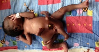 Doctors in Uganda operate on boy born with 8 limbs