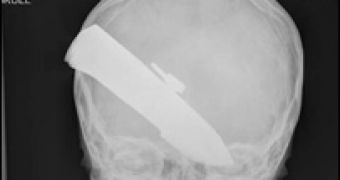 Radiography of the boy's skull with the thrust knife