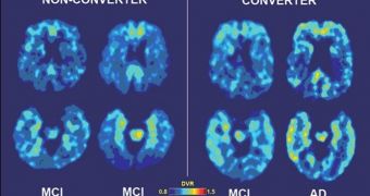 Baseline and follow-up PET scans of a patient who developed Alzheimer's after two years (images to right of white line) that shows high medial temporal binding at baseline (lower left) and follow-up
