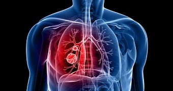 Breath Test Promises to Detect Lung Cancer While in Its Early Stages