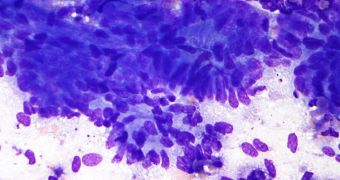 Cancers Delete Suppressing Genes on Chromosomes