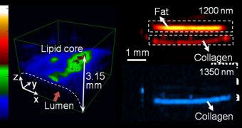 Purdue experts develop a new way of diagnosing cardiovascular disease and other disorders by measuring ultrasound signals from chemical bonds in molecules exposed to a pulsing laser
