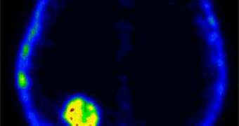 This PET scan, taken just days after radiation therapy, shows a hot spot of cell-death activity in a brain tumor--a good indication that the therapy is working