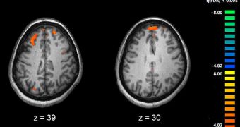 Image showing brain areas more active in controls than in schizophrenia patients during a working memory task surveyed via fMRI.