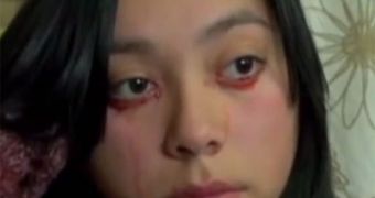 Chilean Woman Has Unusual Condition, Cries Tears of Blood – Video