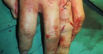 Surgeons create fully-functioning finger from student's toe