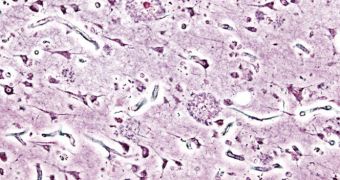 Chromosome Six Gene Dictates Alzheimer's Risk
