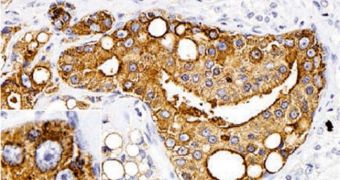 A previous study of chronic fatigue syndrome pointed to a retrovirus found in cancerous prostate cells (magnified in inset)