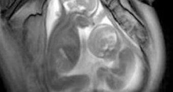Cinematic-MRI Shows Twins Fighting for Room in the Womb – Video